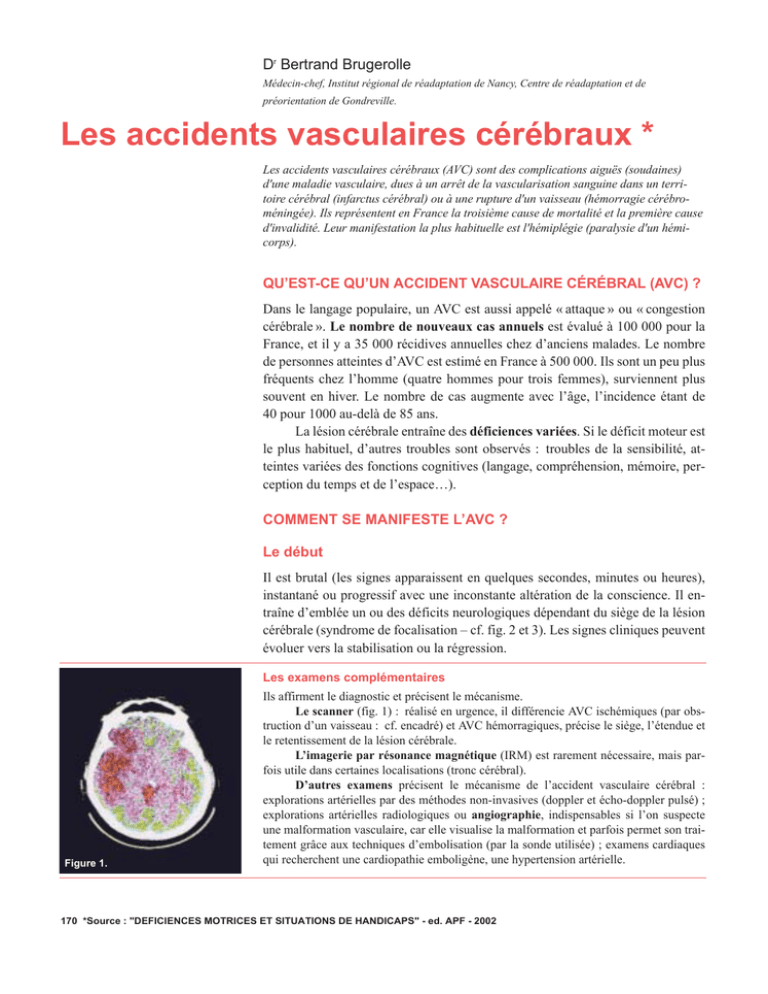 Les Accidents Vasculaires Cérébraux