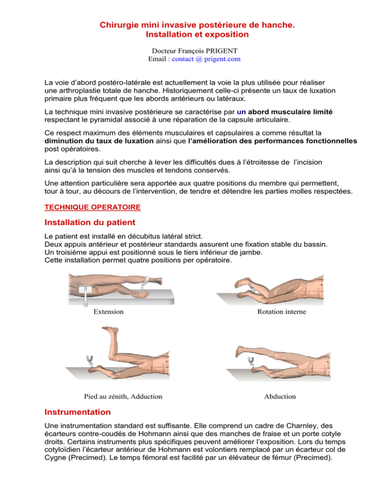 Chirurgie mini invasive postérieure de hanche Installation et